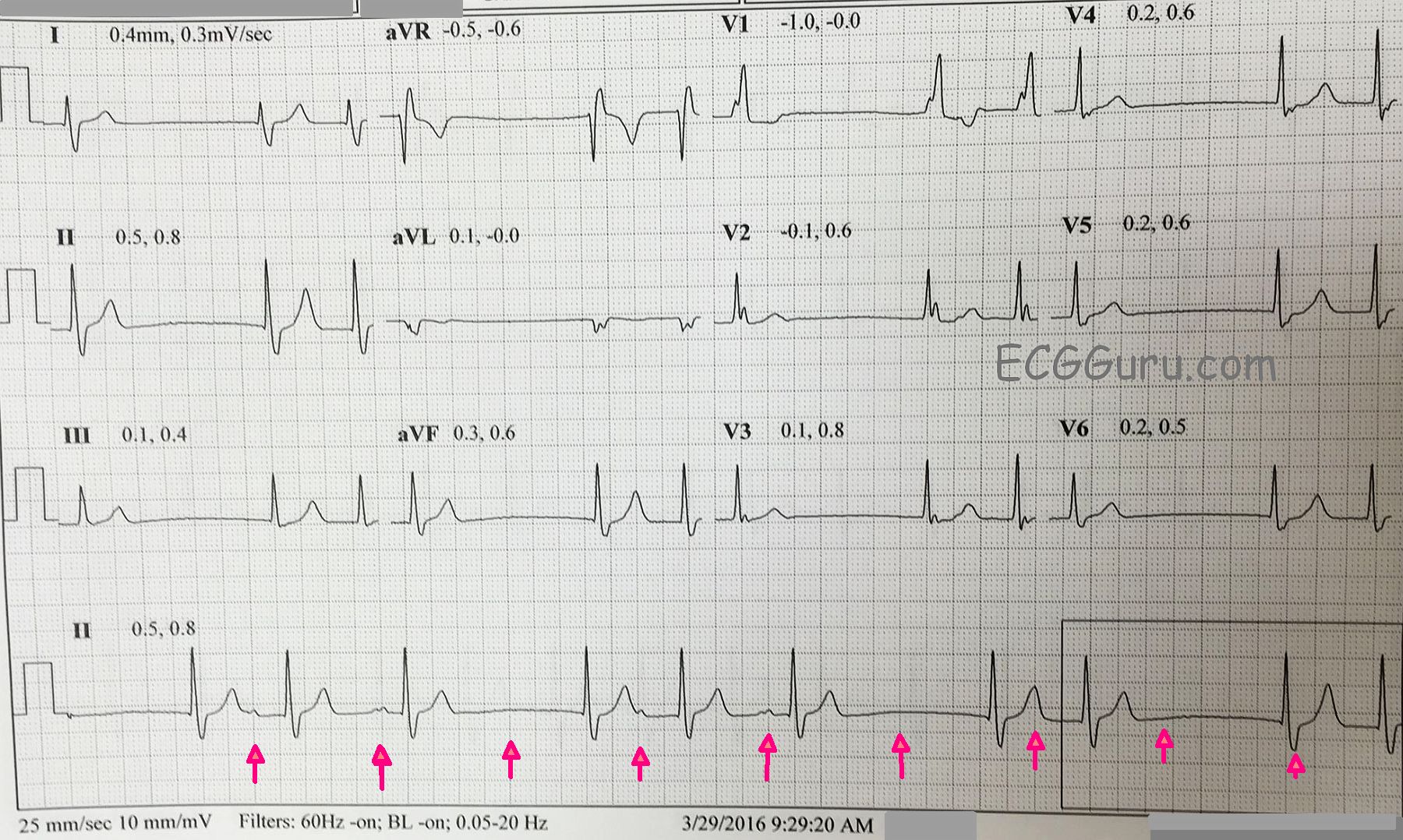 Sinus pause ecg guru instructor resources